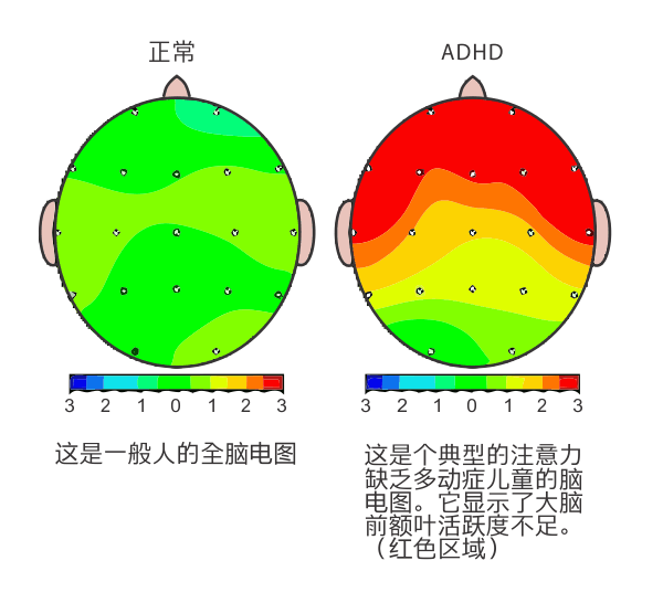 多动症